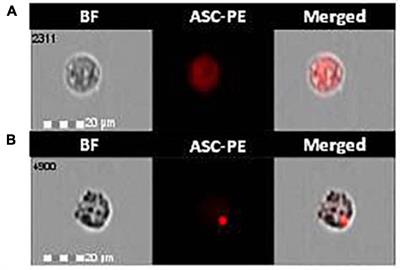 Inflammatory Responses to Monomeric and Aggregated α-Synuclein in Peripheral Blood of Parkinson Disease Patients